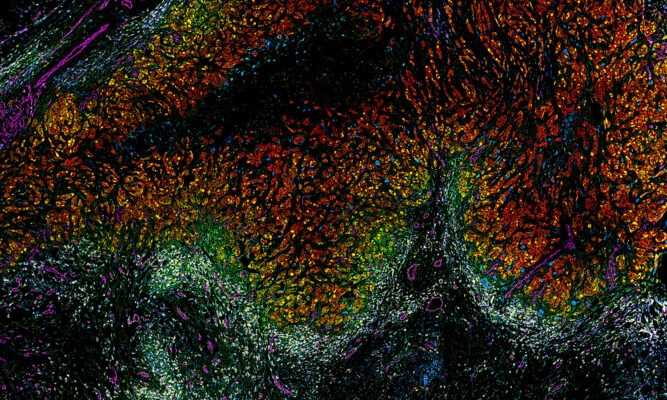 Dana-Farber joins with Parker Institute for Cancer Immunotherapy to accelerate cures for the world’s gravest cancers.